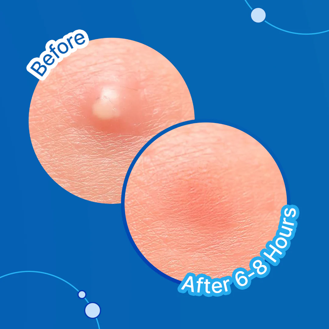 Hydrocolloid Acne Pimple Patch | Salicolloid™ Technology - Image 4