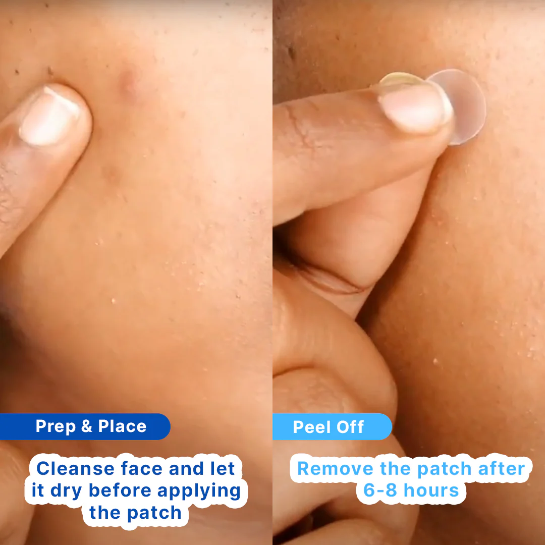 Hydrocolloid Acne Pimple Patch | Salicolloid™ Technology - Image 8